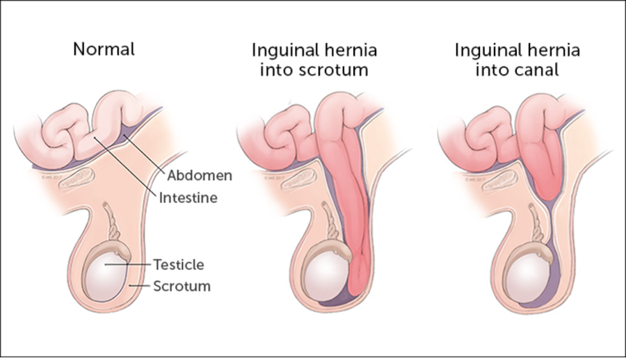 Ilustrație medicală a herniei inghinale la copii — normal vs. hernie în scrot și canal