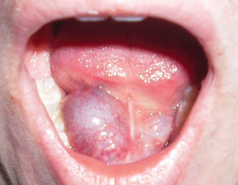 Ranulă (chist sublingual) — umflătură albăstruie situată sub limbă